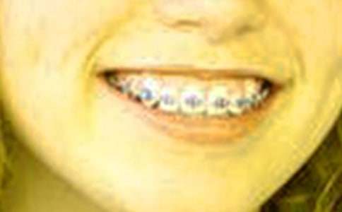 第一次戴牙套600字?jǐn)⑹伦魑模ňx23篇)